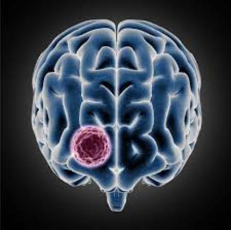 Indicators of Brain Tumors we usually overlook